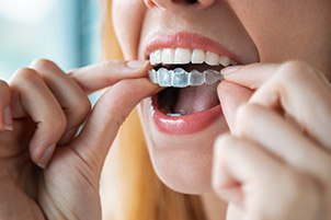 Patient putting on clear aligner