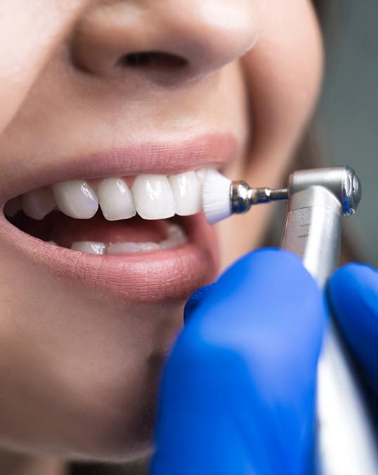 closeup of dentist polishing teeth 