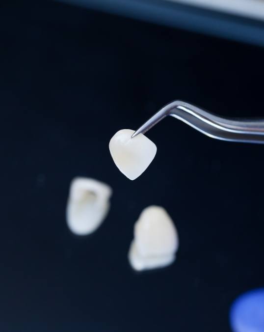 Metal free dental restoration being held in a pair of tweezers
