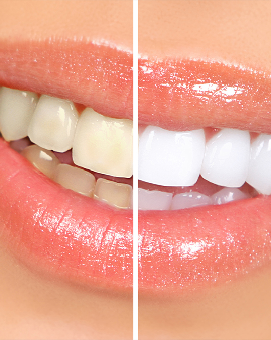 Close up of a smile before and after teeth whitening