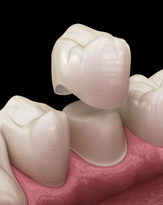 a digital illustration of a dental crown