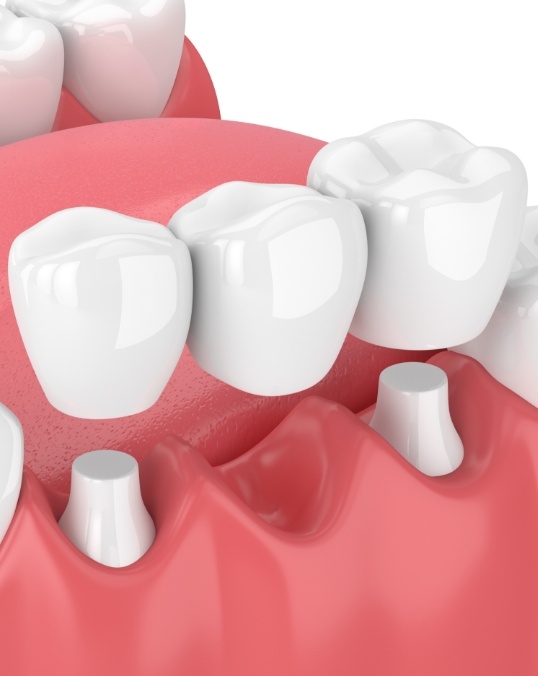 Animated fixed dental bridge replacing a missing lower tooth
