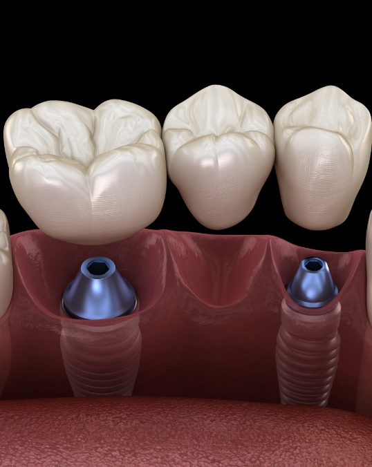 Animated dental bridge being placed over two dental implants