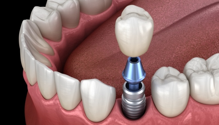 Animated dental implant with dental crown replacing one missing tooth