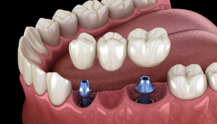 Animated dental implant with dental bridge replacing multiple missing teeth
