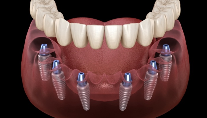 Animated implant denture replacing a full row of missing teeth