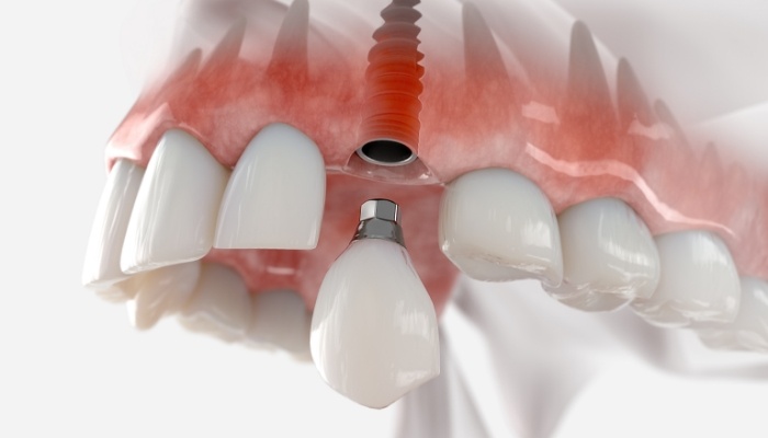 Animated dental implant with dental crown being placed in the upper jaw