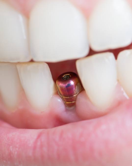 Close up of a smile with a visible dental implant abutment