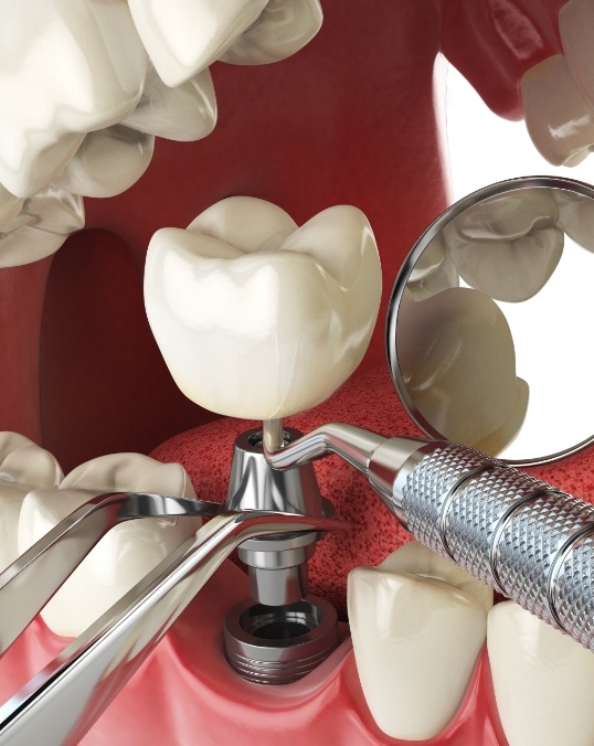 Animated model of a dental implant being placed in the lower arch