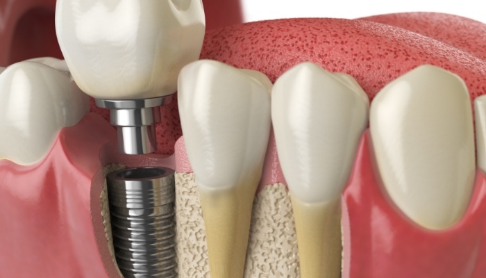 Animated dental crown and abutment being placed over a dental implant