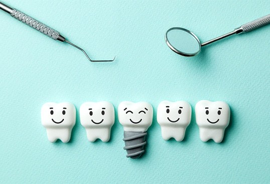 Illustration of dental implant