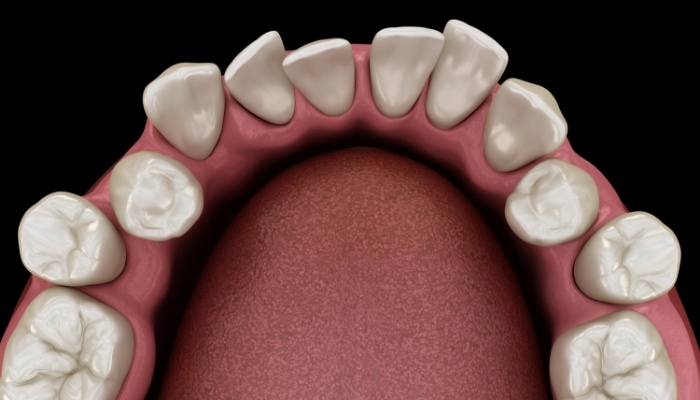 Animated row of misaligned lower teeth