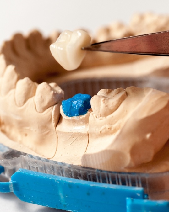 Metal free dental crown being placed in a model of the mouth