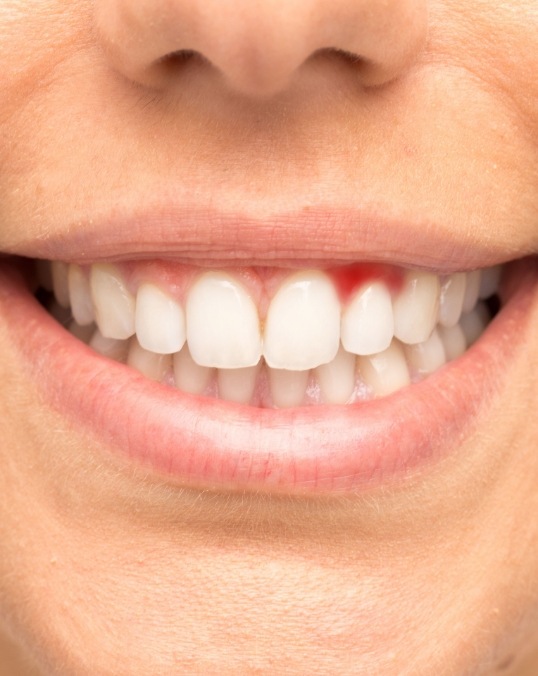 Close up of a smile with an area of redness in the gums