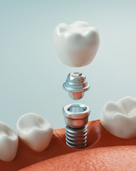 a digital illustration of a dental implant in Saint Peters