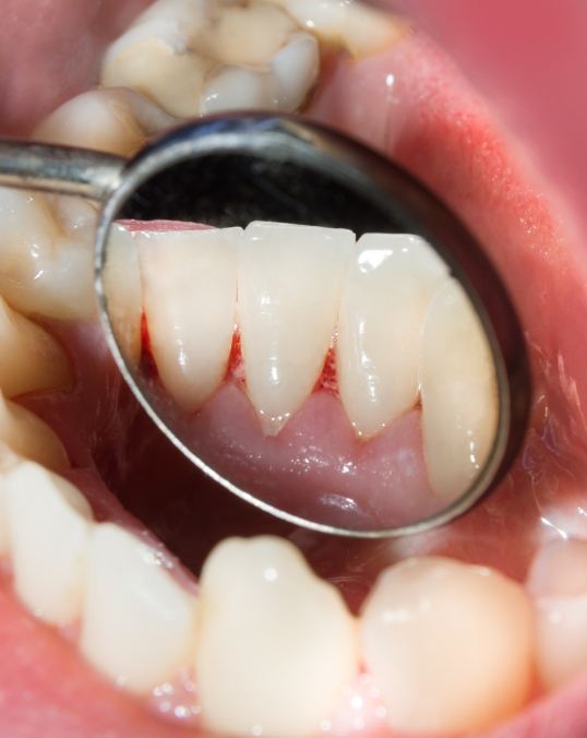 Close up of a mouth with small areas of red gums between the teeth