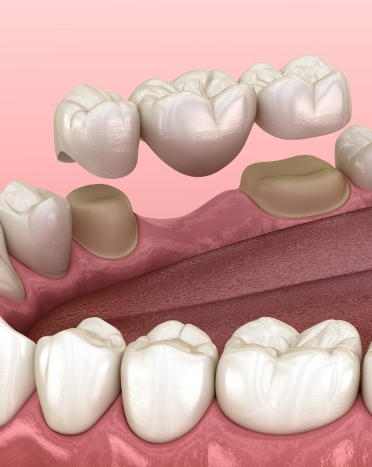 Animated dental bridge replacing a missing tooth