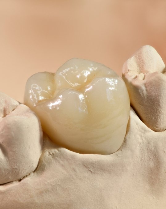 Lifelike dental crown in a model of the jaw