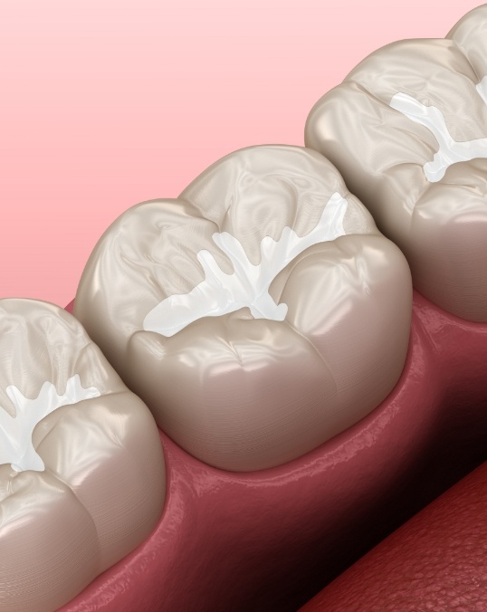 Animated row of teeth with tooth colored fillings