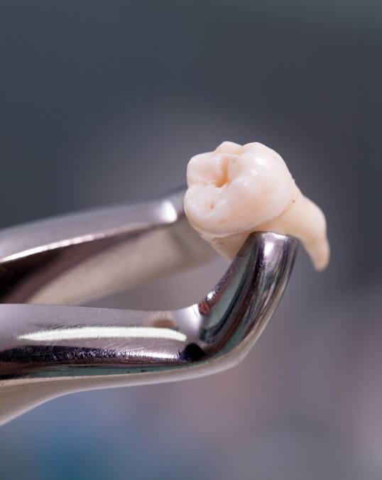 Extracted tooth being held in a pair of dental forceps