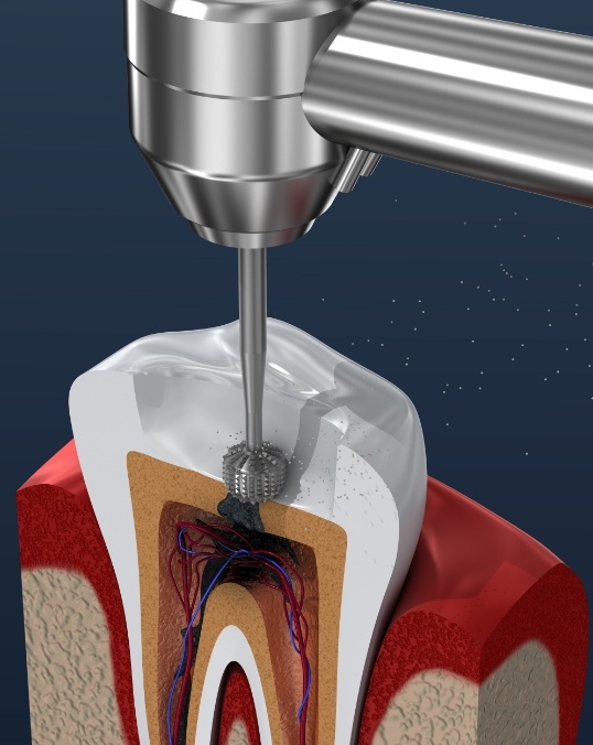 Animated dental tool inside of a tooth performing root canal treatment