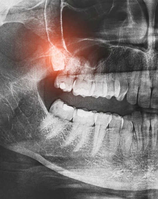 Dental X ray showing an impacted wisdom tooth