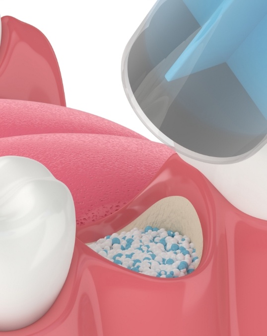 Animated dental bone grafting material being placed into the site of a tooth extraction