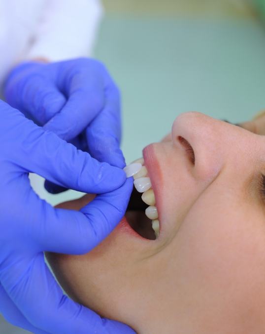 Dentist placing a veneer over a dental patient's tooth