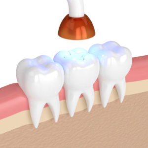 Model of tooth-colored filling